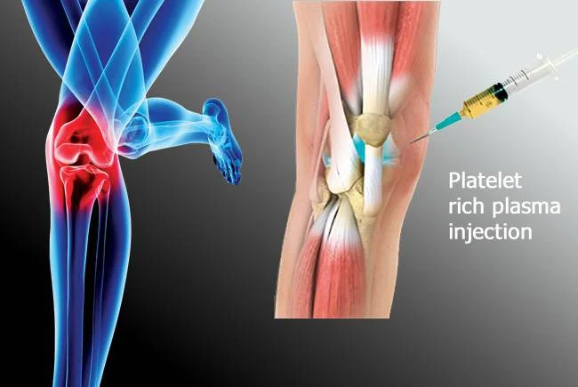 PRP Knee Pain Treatment in Karachi